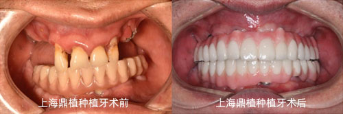 上海鼎植口腔医院怎么样?曝光多组缺骨种植牙对比照和价格