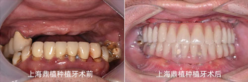 上海鼎植口腔医院全口种植牙重建<span style=