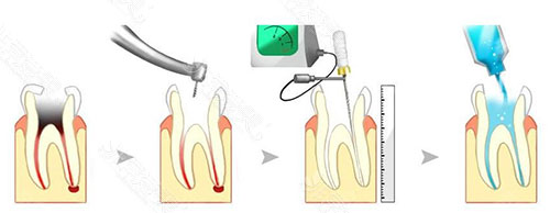 牙齿治疗手术过程图