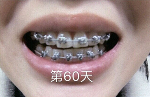 上海松丰齿科金属托槽矫正60天<span style=