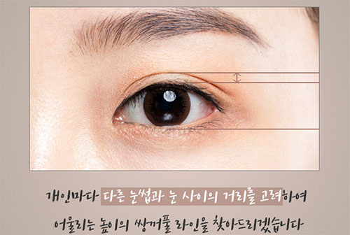 韩国EH爱护眼整形医院案例