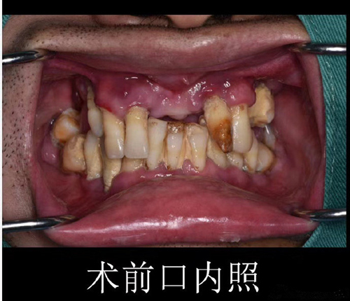 慈溪鼎植口腔医院牙齿种植案例
