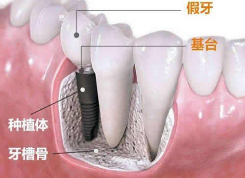 国产种植牙和进口种植牙价格科普