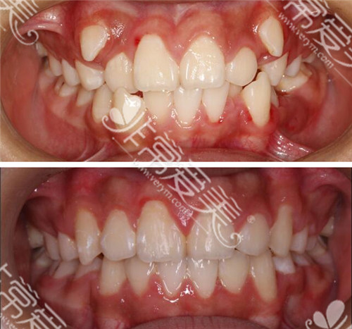 看了昆明美奥口腔医院4组牙齿矫正照片后,我感觉倍好倍靠谱