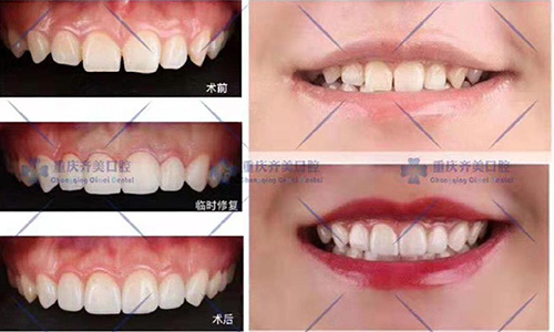 重庆齐美口腔种植牙,牙齿矫正全瓷牙价格曝光,觉得贵不贵？
