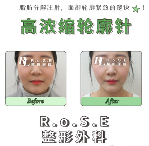 韩国玫瑰ROSE整形外科轮廓针案例