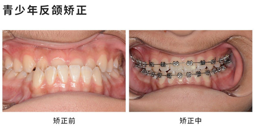 深圳銘德口腔青少年反頜矯正<span style=