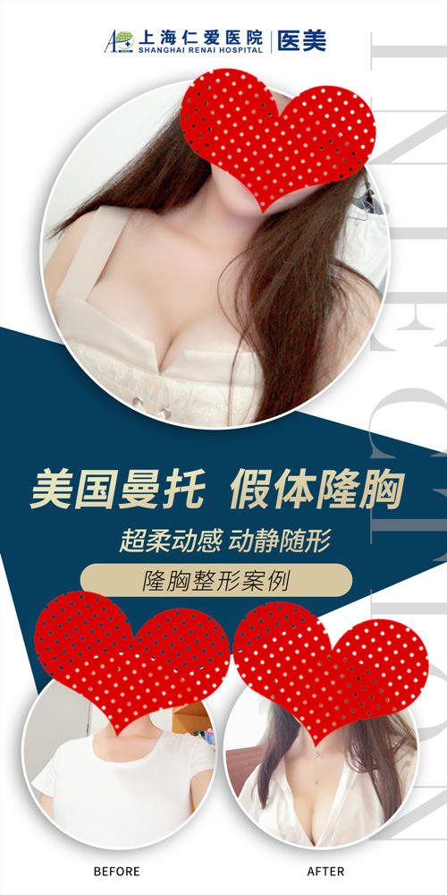 上海仁爱整形医院隆胸案例 上海仁爱整形医院隆胸案例
