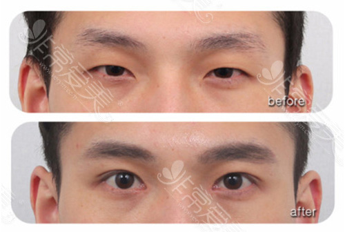 男性双眼皮手术前后对比