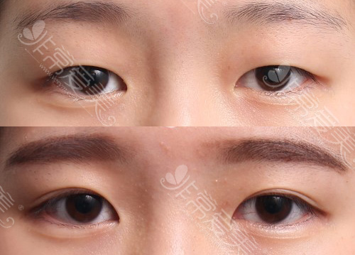 女性双眼皮术前后对比