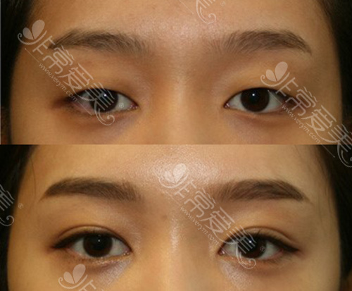 女性双眼皮手术前后对比