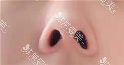 用隐形神器后的鼻子 用隐形神器后的鼻子