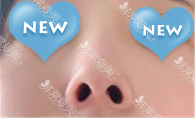 没用隐形神器前的鼻子 没用隐形神器前的鼻子