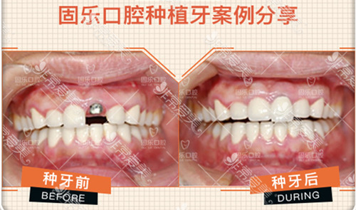 郑州固乐口腔医院种植牙真人照片分享,前后疗效不要太明显!