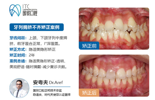 东莞国贸口腔牙齿矫正前后