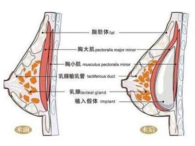 假体植入胸部解剖图