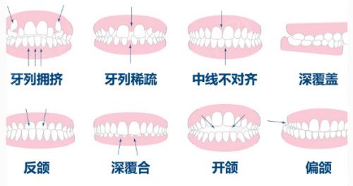 牙齿不齐的多种情况