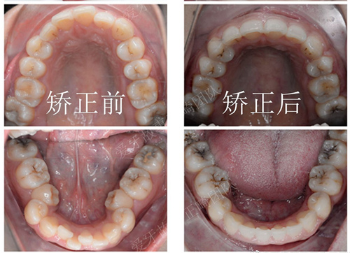 温州爱牙故事王国林牙齿矫正案例
