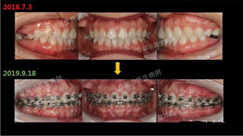 广州德伦口腔牙齿矫正<span style=