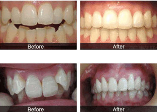深圳格倫菲爾正畸前后對(duì)比