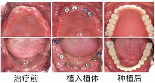 上海摩爾星松全口種植牙<span style=