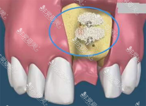 冷知识:你猜种植牙植骨粉一次多少钱?按克收费堪比黄金！
