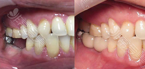 种植牙效果对比