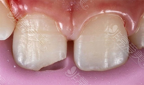 牙模与牙齿参照对比