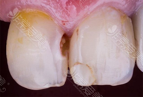 牙齿修复前状况