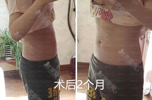 韩国WIZ&美整形腰腹吸脂2个月照片