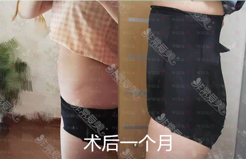 韩国WIZ&美整形腰腹环吸一个月的图片