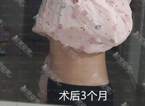 韩国WIZ&美整形腰腹吸脂三个月图片
