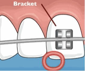 托槽牙齿矫正器工作原理动图
