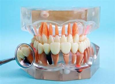 种植牙口腔模型