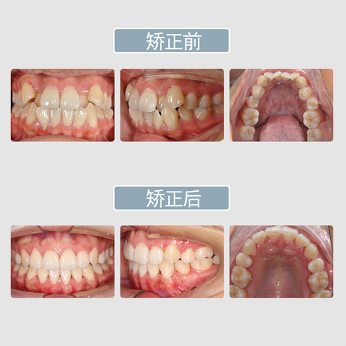 深圳同步齒科牙齒矯正