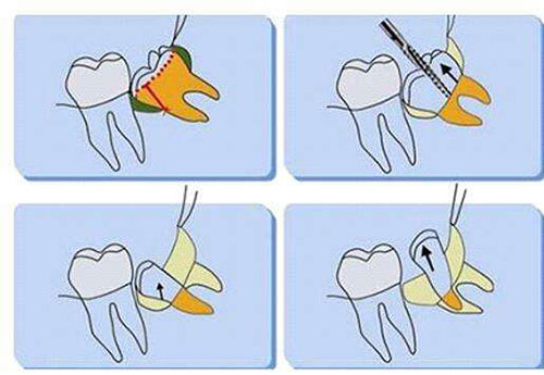 智齿的拔出过程