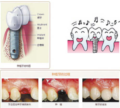 勁松口腔醫(yī)院種植案例