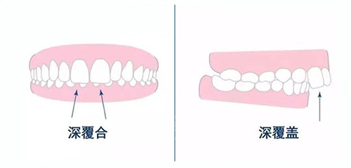 深覆合不矫正的话将来会咋样?深覆合矫正前后脸型变化好大