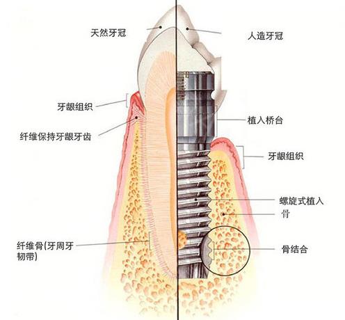 寧夏華美口腔種植體結(jié)構(gòu)圖