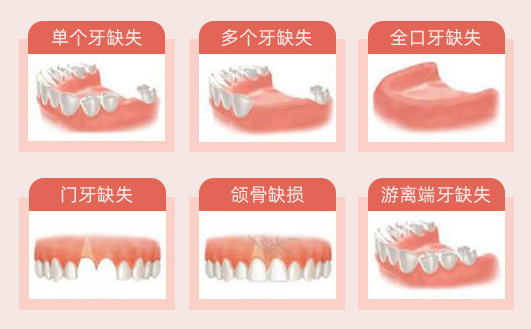 寧夏華美口腔牙齒缺失問題圖