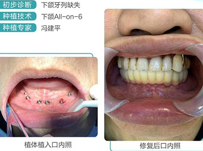 鄭州華西口腔半口種植照片