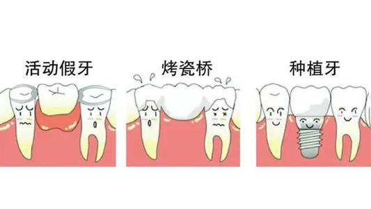 缺失牙的修复方式