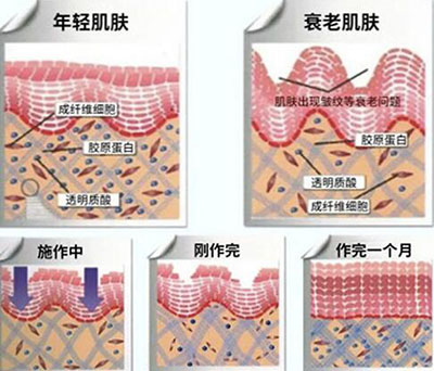 石家庄哪家医院有热玛吉?据说做一次只需8800,是真的假的?