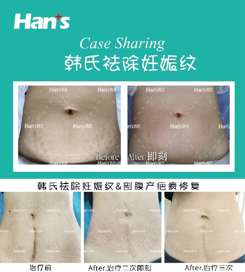 济南韩氏整形医院祛妊娠纹<span style= 济南韩氏整形医院祛妊娠纹<span style=