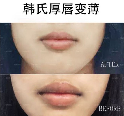 济南韩氏整形医院厚唇变薄<span style= 济南韩氏整形医院厚唇变薄<span style=