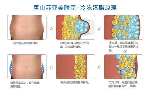 唐山苏亚美联臣冷冻溶脂原理