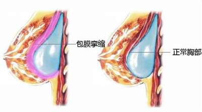 隆胸后包膜挛缩示意图