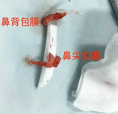 上海时光整形医院鼻修复手术取出假体