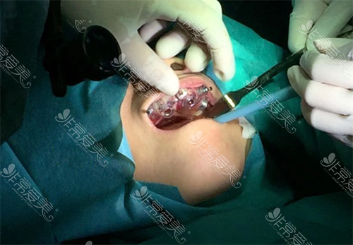 allon4种植牙手术步骤图片