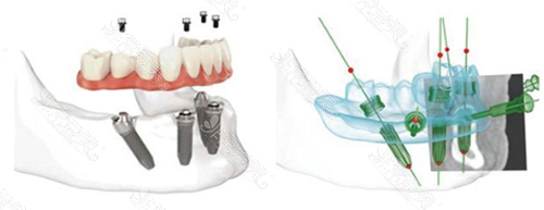 allon4种植牙过程示意图